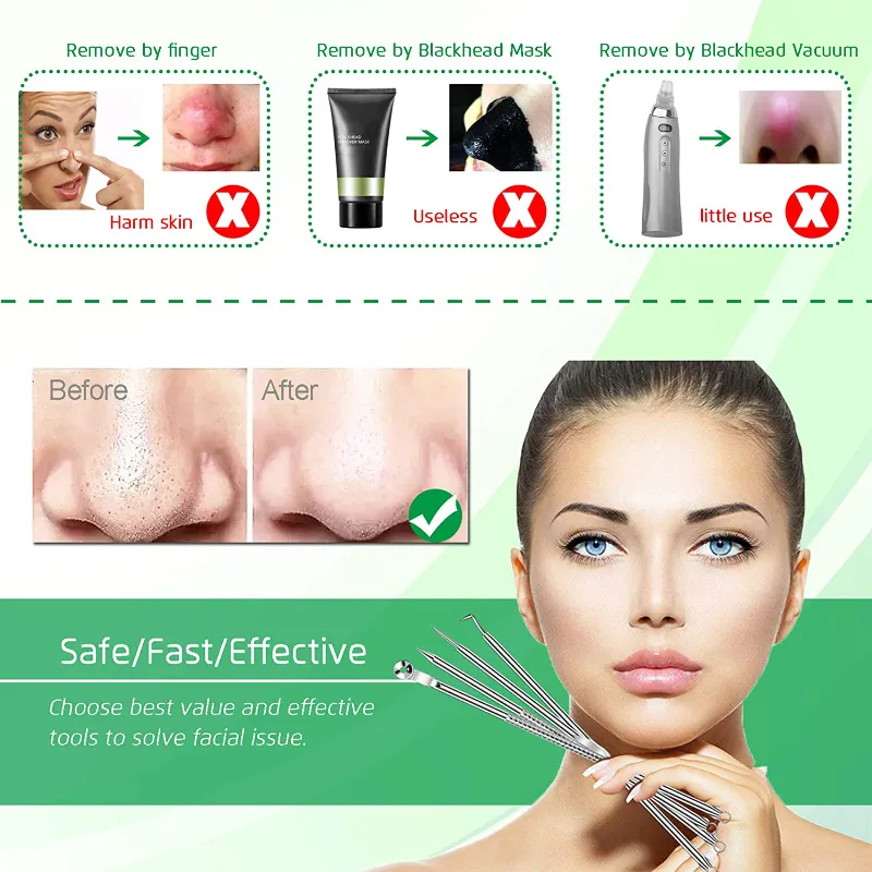 5 Piece Blackhead Remover Extractor Tool Kit